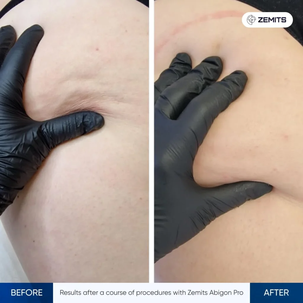 Abigon Pro Body Remodelling and Skin Tightening