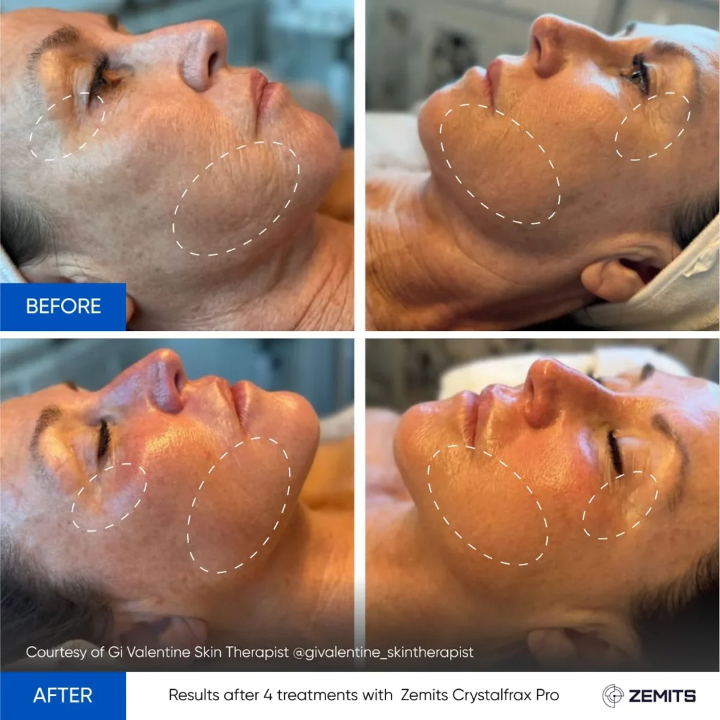 RF Skin Tightening for Face & Neck at Blissimo Skin & Body Clinic