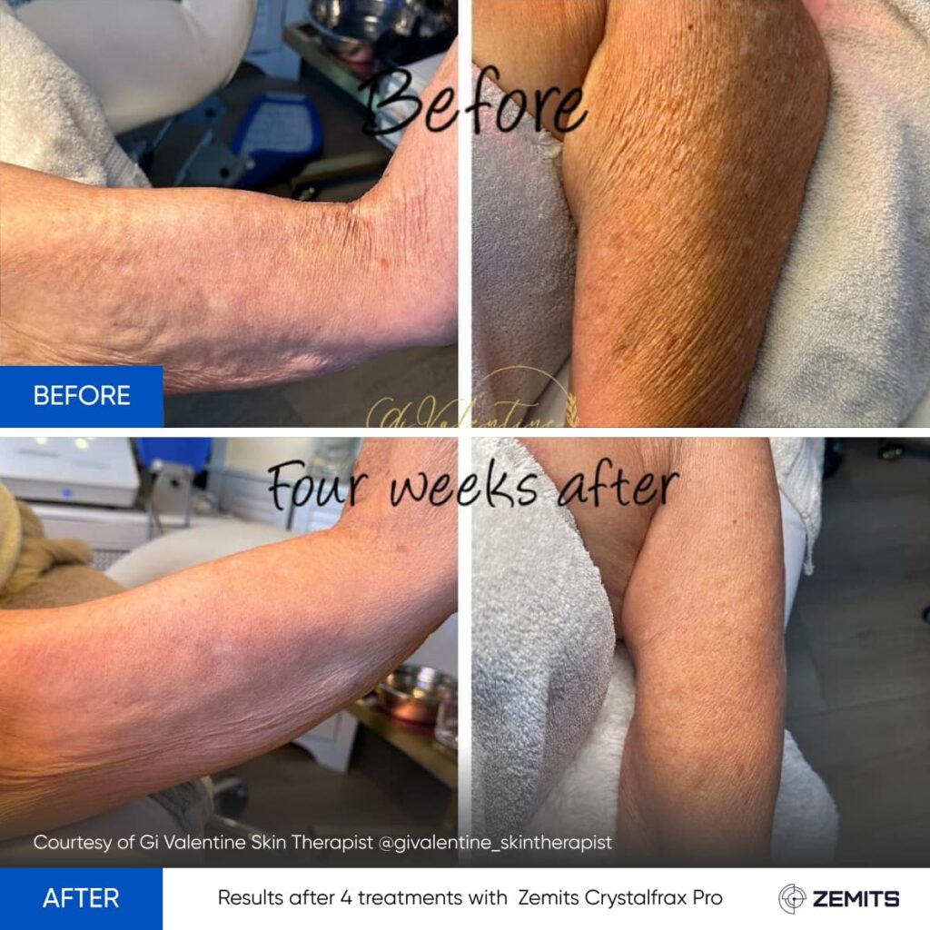 RF Skin Tightening for the Body at Blissimo Skin & Body Clinic